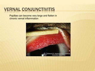 VERNAL CONJUNCTIVITIS
Papillae can become very large and flatten in
chronic vernal inflammation
 
