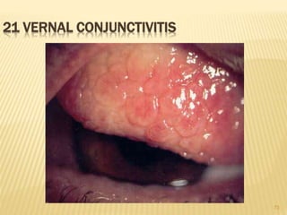 73
21 VERNAL CONJUNCTIVITIS
 