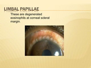 LIMBAL PAPILLAE
These are degenerated
eosinophils at corneal scleral
margin.
 