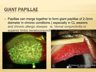 GIANT PAPILLAE
 Papillae can merge together to form giant papillae of 2-3mm
diameter in chronic conditions ( especially in CL wearers
and chronic allergic disease ie. Vernal conjunctivitis or
superior limbic keratoconjunctivitis
 