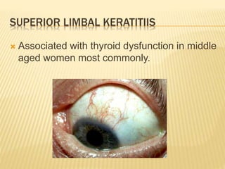 SUPERIOR LIMBAL KERATITIIS
 Associated with thyroid dysfunction in middle
aged women most commonly.
 