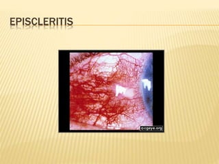 EPISCLERITIS
 