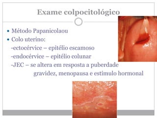 Exame colpocitológico
 Método Papanicolaou
 Colo uterino:
-ectocérvice – epitélio escamoso
-endocérvice – epitélio colunar
-JEC – se altera em resposta a puberdade
gravidez, menopausa e estímulo hormonal
 