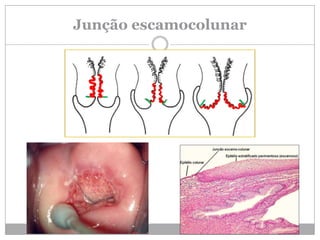 Junção escamocolunar
 