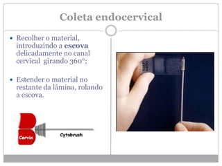 Coleta endocervical
 Recolher o material,
introduzindo a escova
delicadamente no canal
cervical girando 360°;
 Estender o material no
restante da lâmina, rolando
a escova.
 