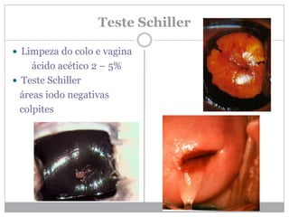 Teste Schiller
 Limpeza do colo e vagina
ácido acético 2 – 5%
 Teste Schiller
áreas iodo negativas
colpites
 