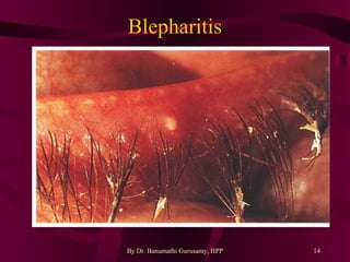 Eye Infections | PPT