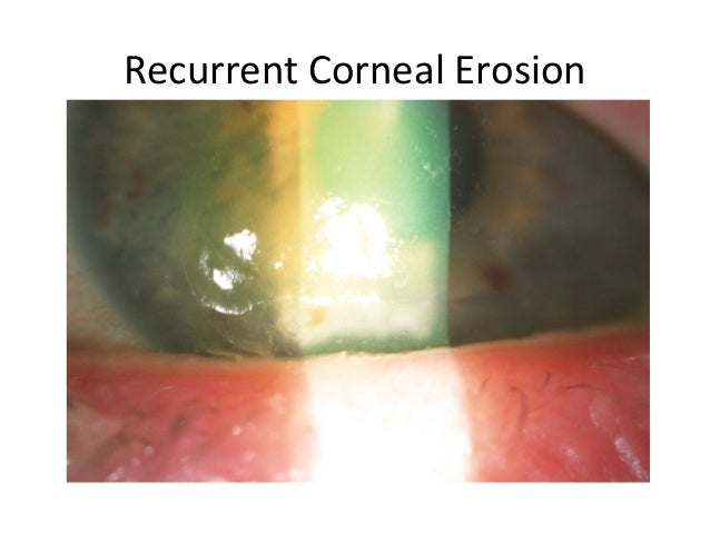 cornea 10 638