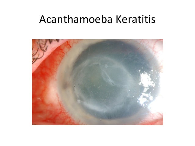Cornea