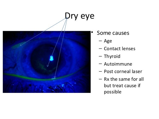 Cornea
