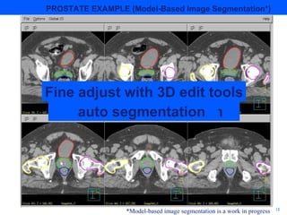 4 D Adaptive Radiotherapy & Tomotherapy | PPT