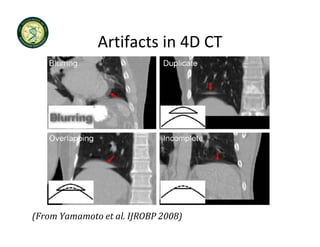 Artifacts in 4D CT
              Artifacts in 4D CT




(From Yamamoto et al. IJROBP 2008)
 