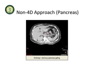 Non 4D Approach (Pancreas)
Non‐4D Approach (Pancreas)
 