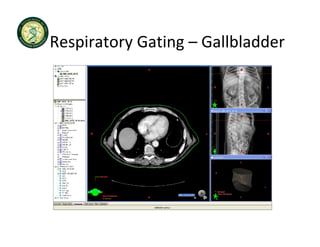Respiratory Gating  Gallbladder 
Respiratory Gating – Gallbladder
 