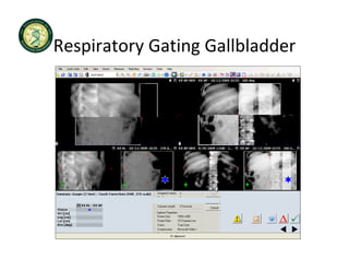 Respiratory Gating Gallbladder
Respiratory Gating Gallbladder
 
