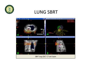 LUNG SBRT
LUNG SBRT
 
