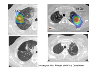 18 Gy
18 Gy




        Courtesy of John Fiveash and Chris Dobelbower
 