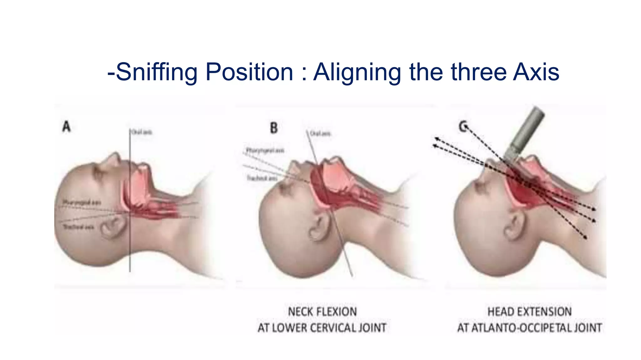 difficult airway management-Anesthesia | PDF