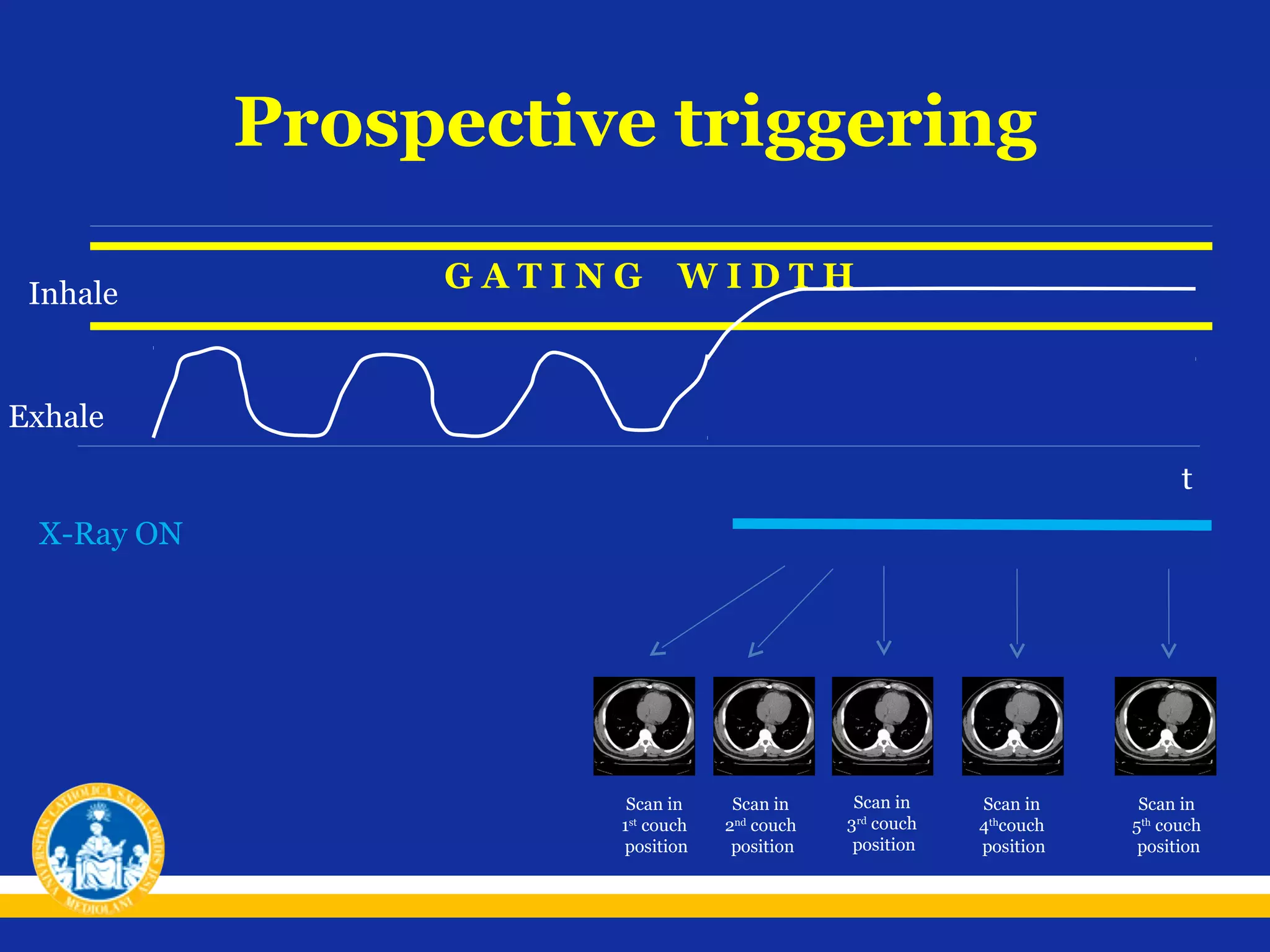 Prospective triggering
Inhale

GATING

WIDTH

Exhale
t
X-Ray ON

Scan in
1st couch
position

Scan in
2nd couch
position

Scan in
3rd couch
position

Scan in
4thcouch
position

Scan in
5th couch
position

 