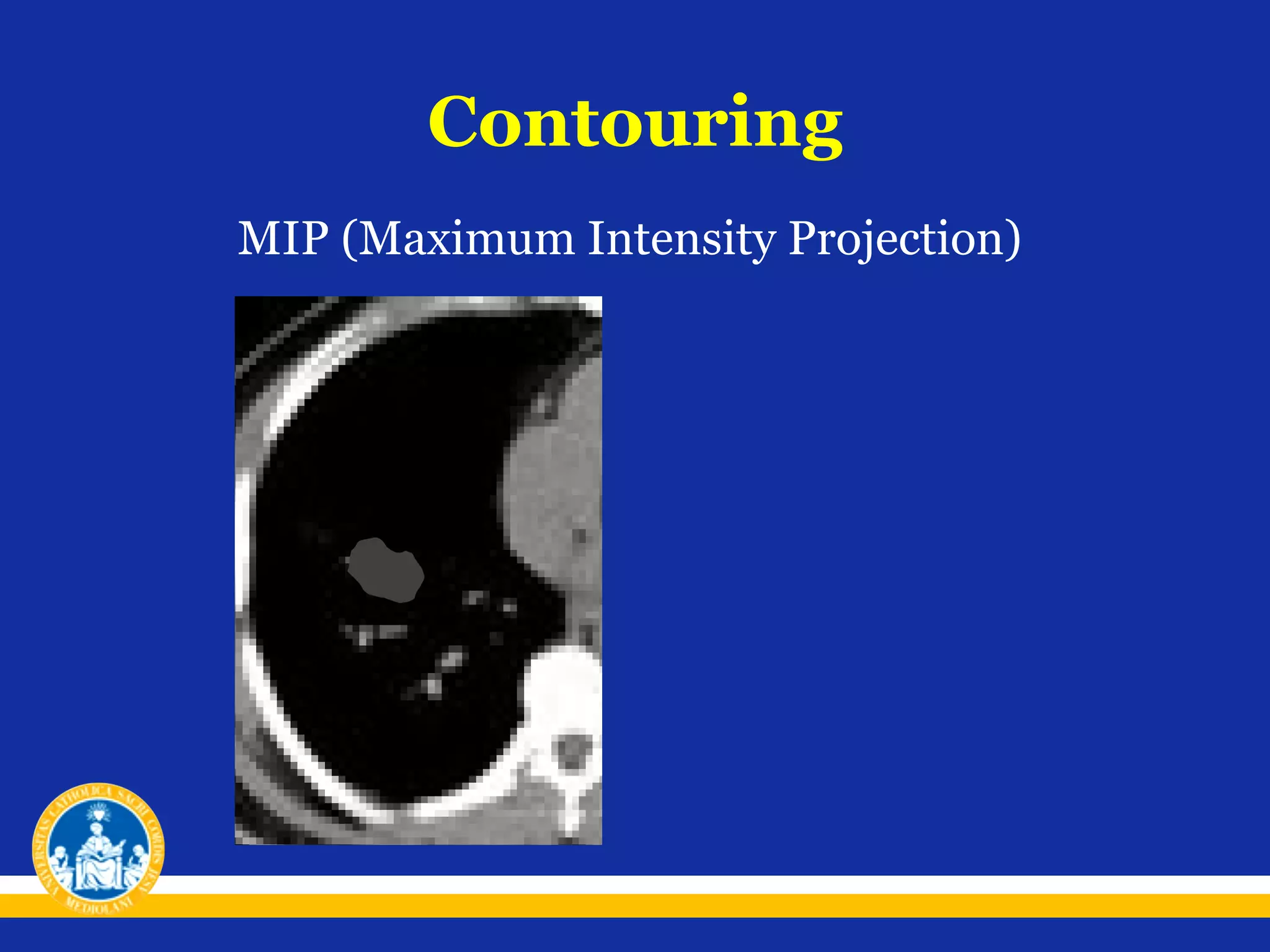 Contouring
MIP (Maximum Intensity Projection)

 