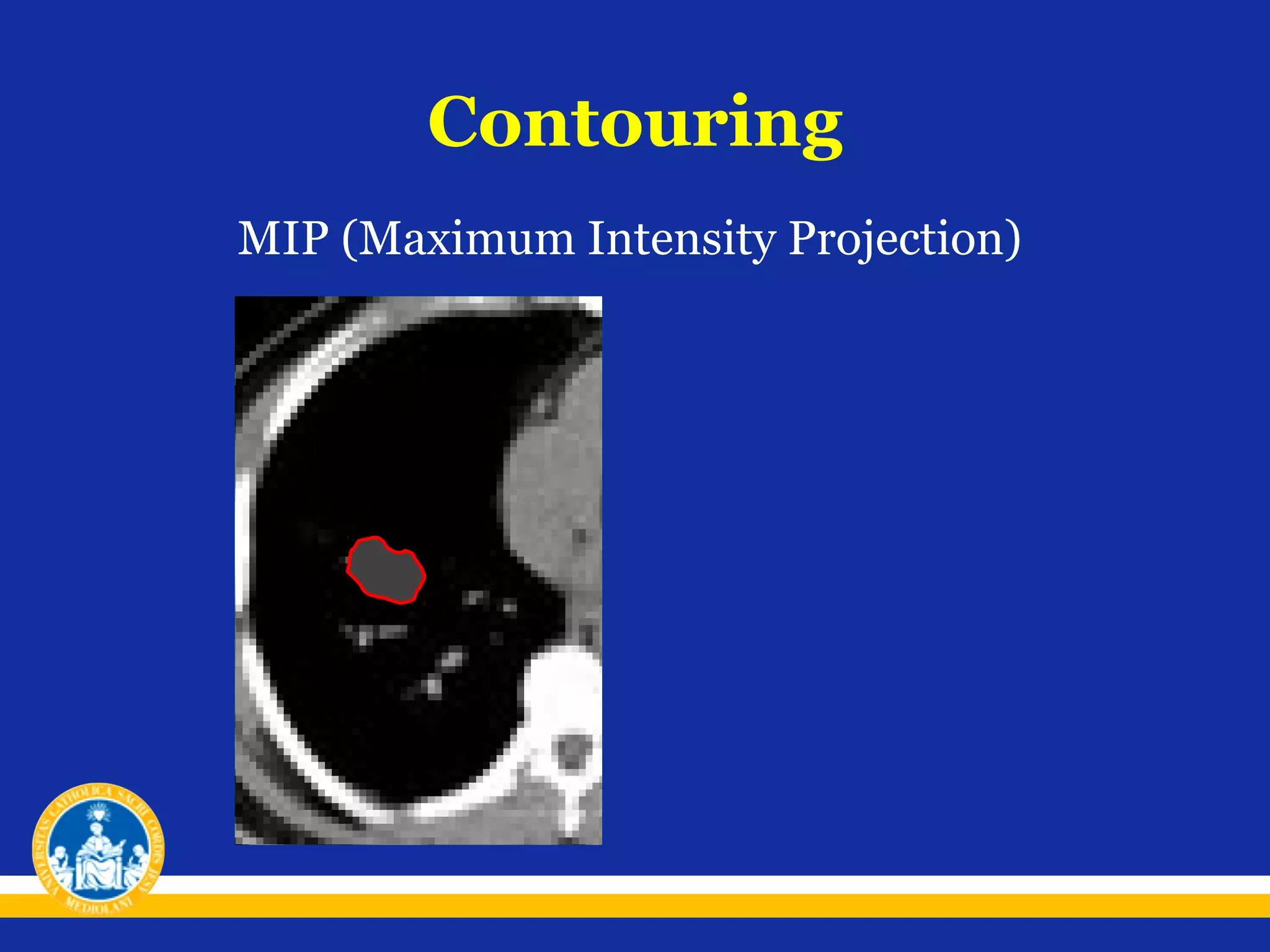 Contouring
MIP (Maximum Intensity Projection)

 
