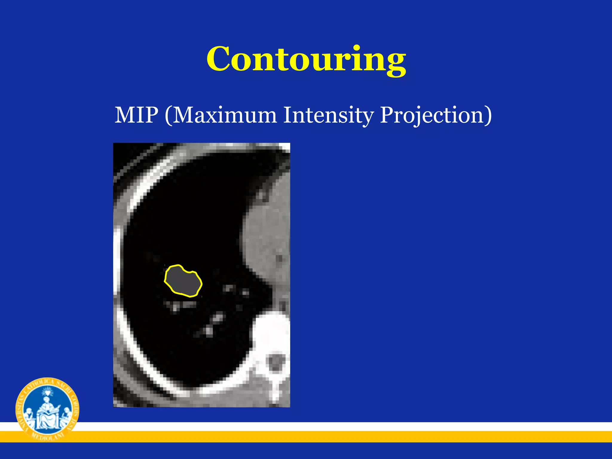 Contouring
MIP (Maximum Intensity Projection)

 