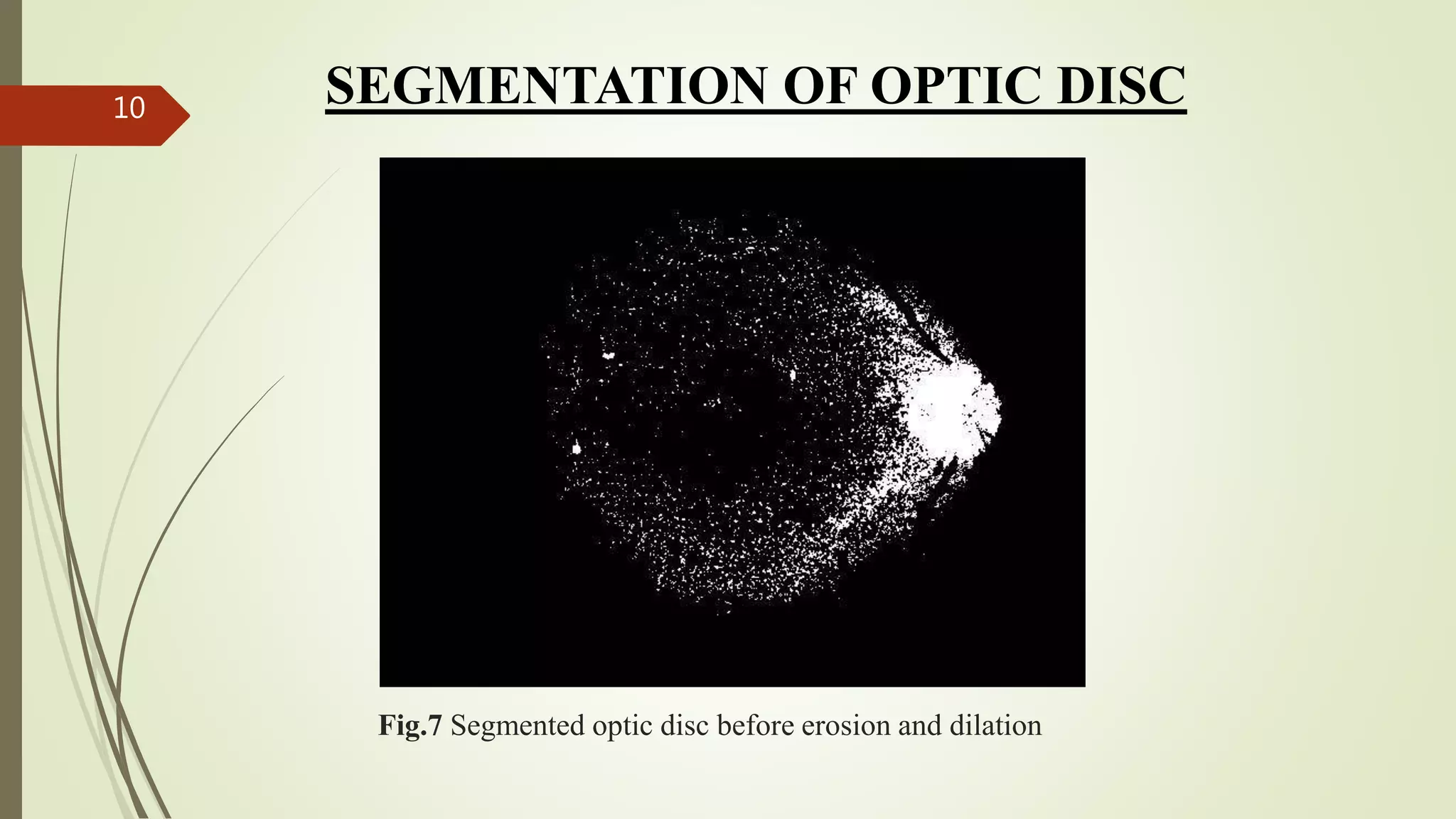 Fig.7 Segmented optic disc before erosion and dilation
10 SEGMENTATION OF OPTIC DISC
 