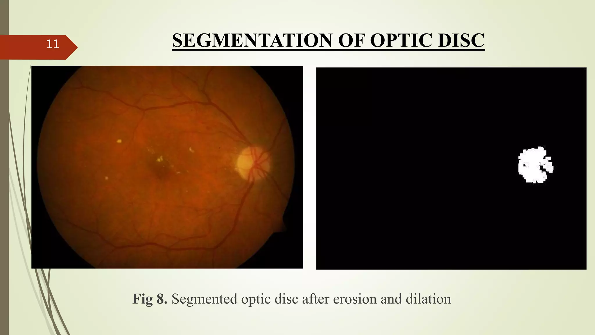 Fig 8. Segmented optic disc after erosion and dilation
11 SEGMENTATION OF OPTIC DISC
 