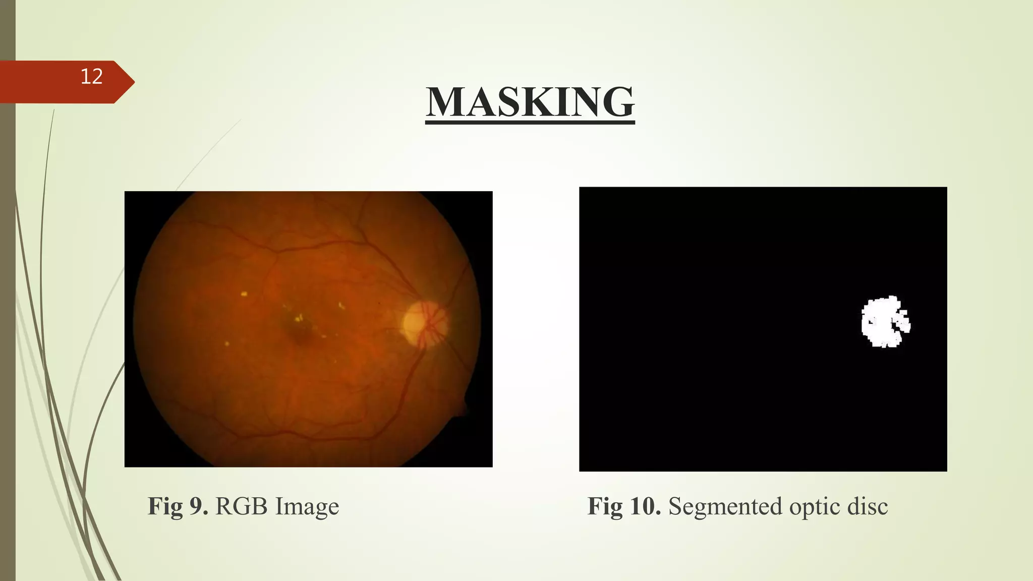 MASKING
Fig 9. RGB Image Fig 10. Segmented optic disc
12
 