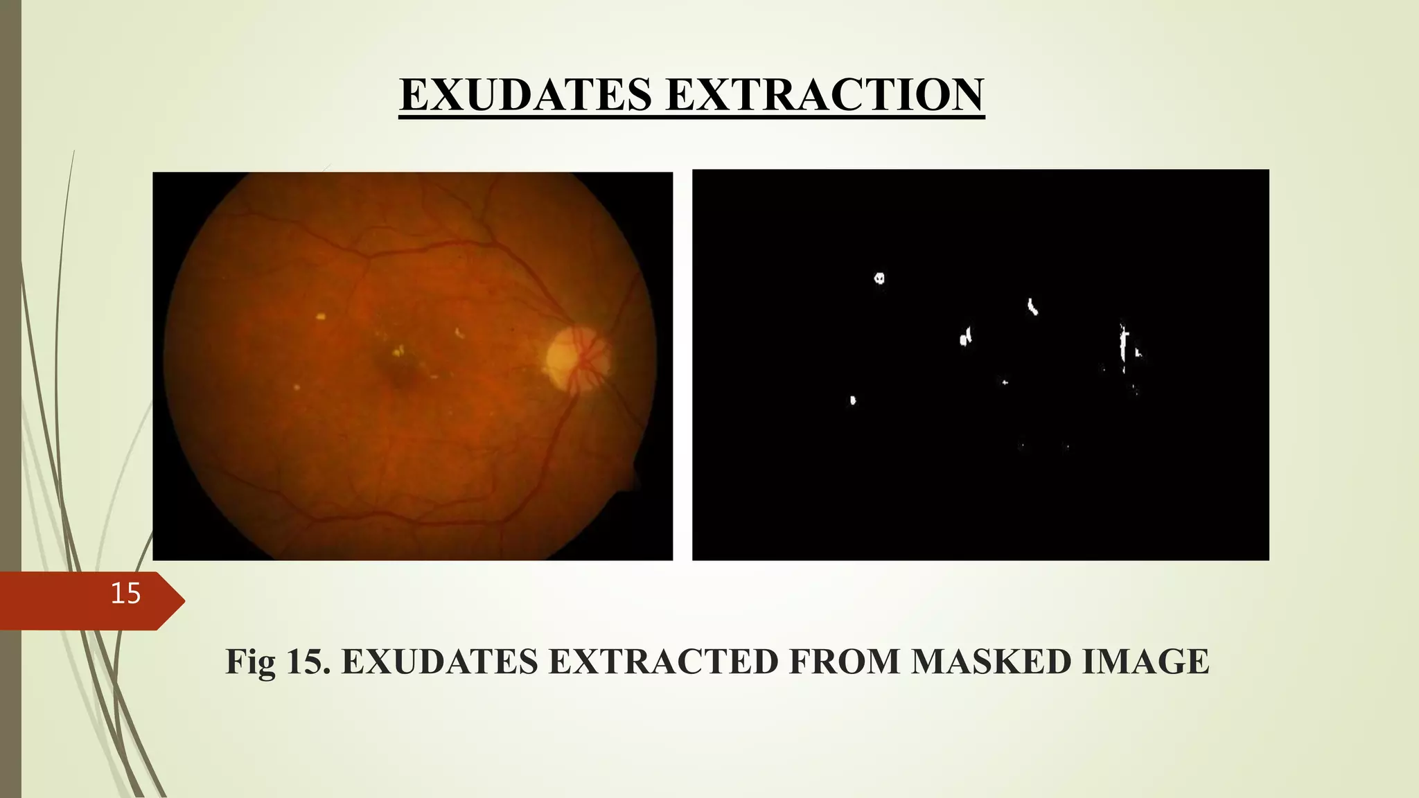 Fig 15. EXUDATES EXTRACTED FROM MASKED IMAGE
EXUDATES EXTRACTION
15
 