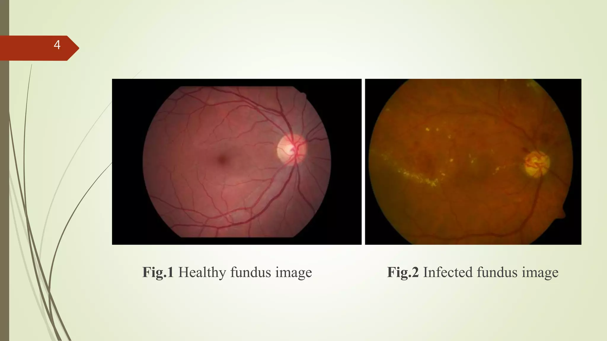Fig.1 Healthy fundus image Fig.2 Infected fundus image
4
 