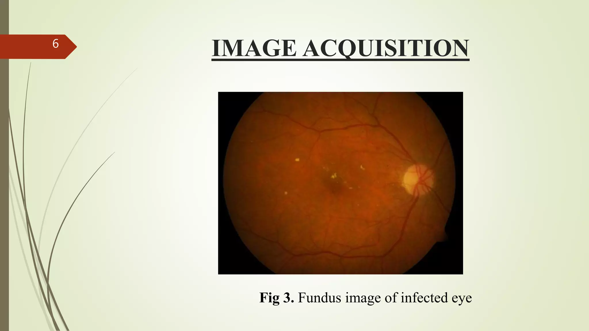 IMAGE ACQUISITION6
Fig 3. Fundus image of infected eye
 