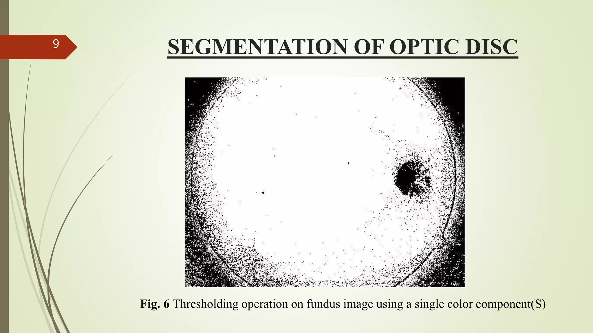 SEGMENTATION OF OPTIC DISC9
Fig. 6 Thresholding operation on fundus image using a single color component(S)
 