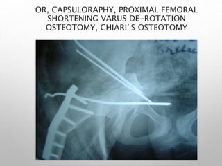 Varus Rotation Osteotomy 4 ddh principles & protocols 3 & above | PPT
