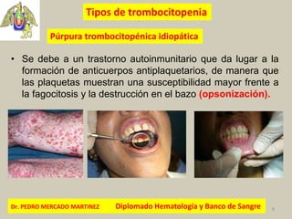Dr. PEDRO MERCADO MARTINEZ Diplomado Hematología y Banco de Sangre 6
Tipos de trombocitopenia
Púrpura trombocitopénica idi...