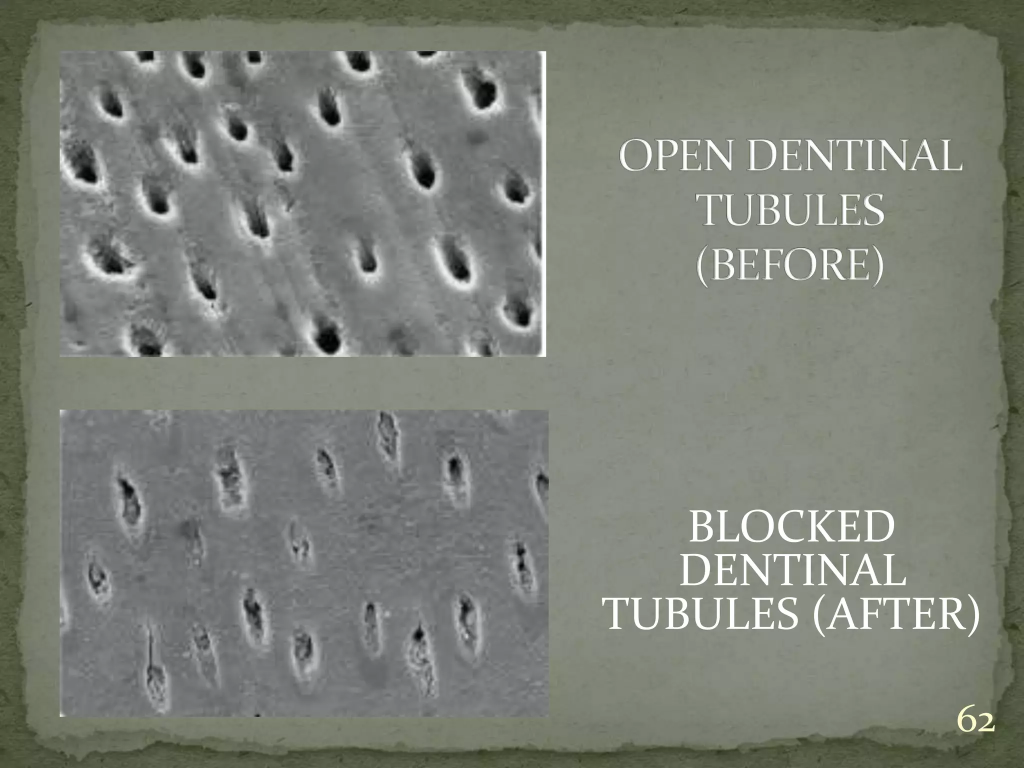 BLOCKED
DENTINAL
TUBULES (AFTER)
62
 