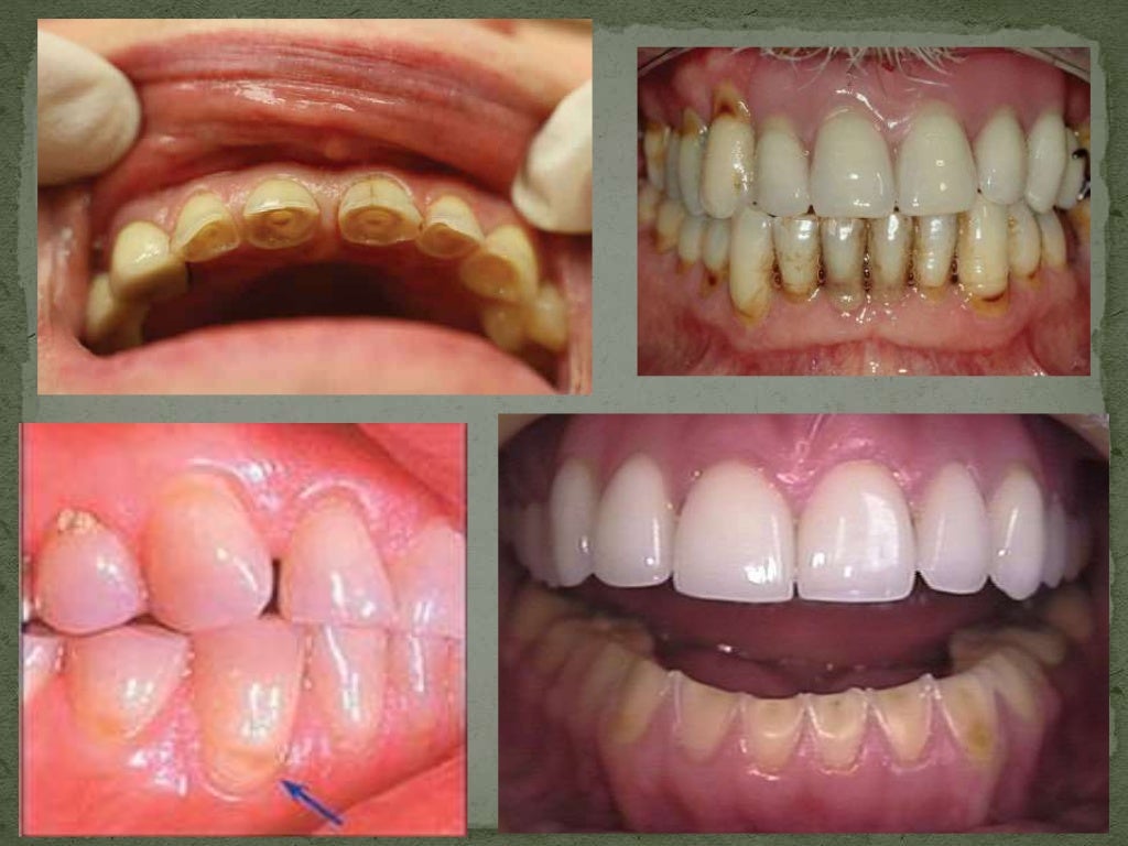 Dentin hypersensitivity