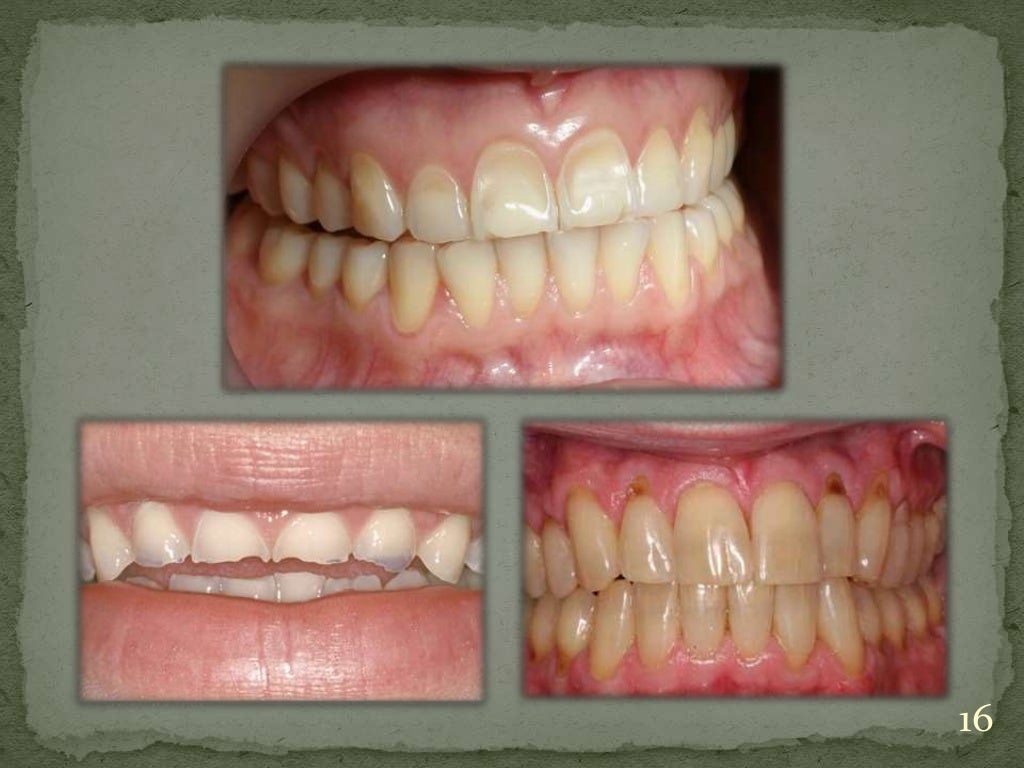 Dentin hypersensitivity