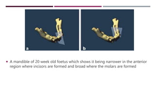  A mandible of 20 week old foetus which shows it being narrower in the anterior
region where incisors are formed and broad where the molars are formed
 