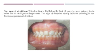 Non spaced dentition: This dentition is highlighted by lack of space between primary teeth
either due to small jaw or larger teeth. This type of dentition usually indicates crowding in the
developing permanent dentition.
 