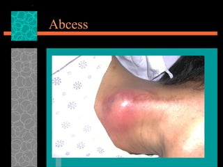 Abses Dm Comprehensive Overview of Diabetes Mellitus: Causes, Symptoms, and ...