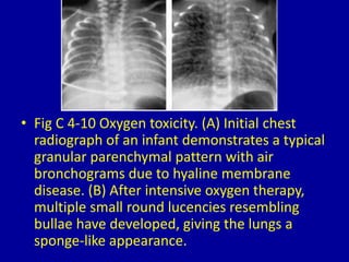 4 diffuse reticular or reticulonodular pattern | PPTX