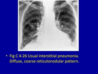 4 diffuse reticular or reticulonodular pattern | PPTX