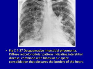4 diffuse reticular or reticulonodular pattern | PPTX