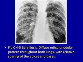 Basilar Reticular Pattern 4 diffuse reticular or reticulonodular pattern | PPTX
