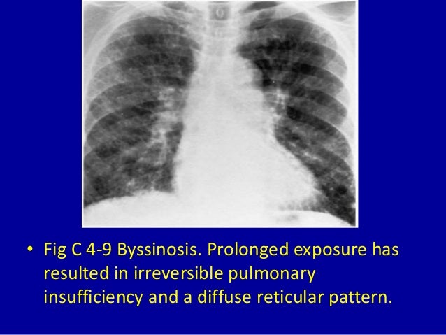 4 diffuse reticular or reticulonodular pattern
