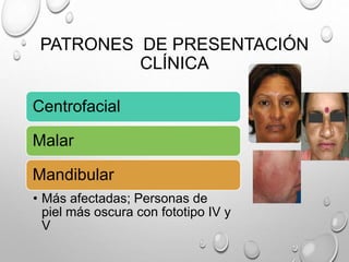 PATRONES DE PRESENTACIÓN
CLÍNICA
Centrofacial
Malar
Mandibular
• Más afectadas; Personas de
piel más oscura con fototipo IV y
V
 