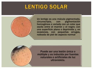 Un lentigo es una mácula pigmentada,
circunscripta, con pigmentación
homogénea o variada con un color que
oscila entre el marrón y el negro; con
una superficie plana o deprimida y, en
ocasiones, con pequeñas arrugas,
rodeada de piel de aspecto normal
Puede ser una lesión única o
múltiple y es inducida por fuentes
naturales o artificiales de luz
ultravioleta.
 