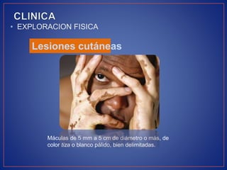 • EXPLORACION FISICA
Lesiones cutáneas
Máculas de 5 mm a 5 cm de diámetro o más, de
color tiza o blanco pálido, bien delimitadas.
 