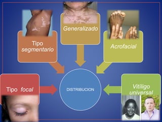 DISTRIBUCIONTipo focal
Tipo
segmentario
Generalizado
Acrofacial
Vitíligo
universal
 